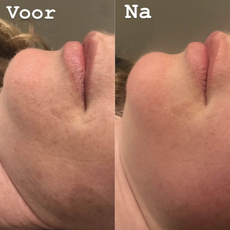 huidveroudering-2